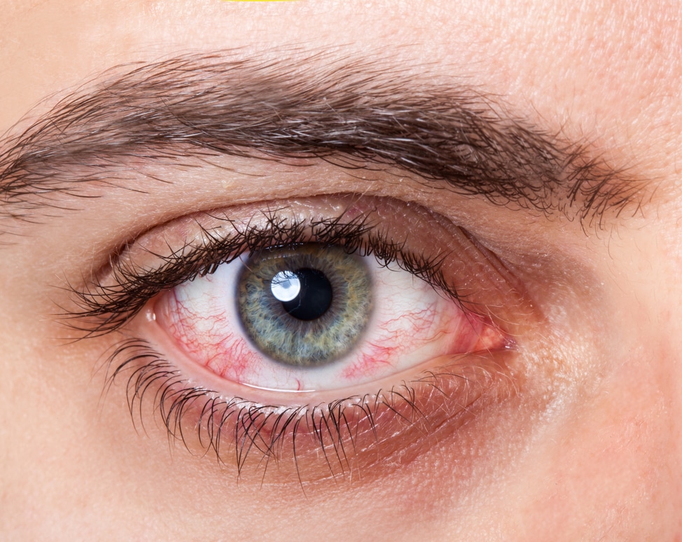 what causes irritated red scratchy eyes